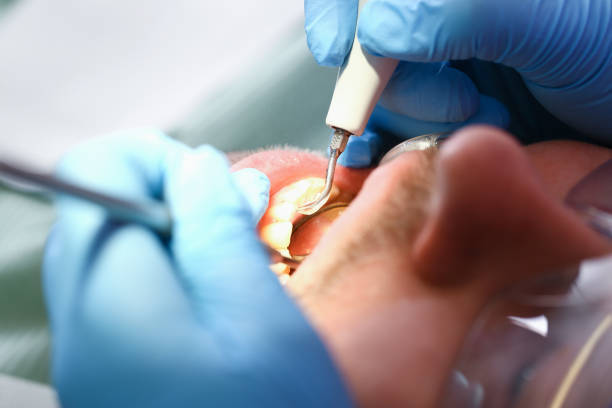 Best Emergency Treatment for Dental Infections or Abscesses in St Bernard, OH