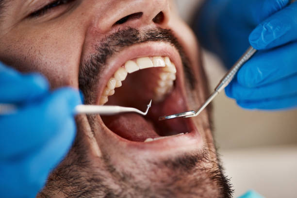 Best Emergency Tooth Extraction in St Bernard, OH