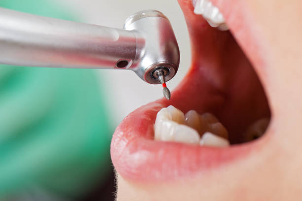 Best Emergency Root Canal Treatment in St Bernard, OH